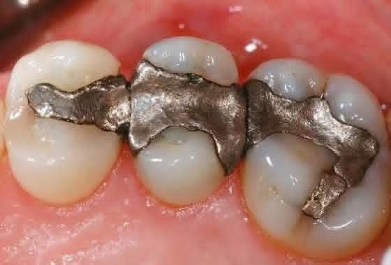 هام جدًا: الحشوات المعدنية القديمة وخطورتها على الصحة