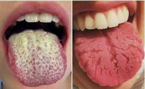 لسانك يكشف حالتك الصحية.. علامات مهمة لا تتجاهلها أبدًا