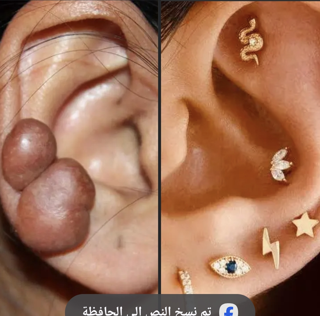 مخاطر ثَقب غضروف الأذن… ظاهرة متزايدة بعواقب خطيرة