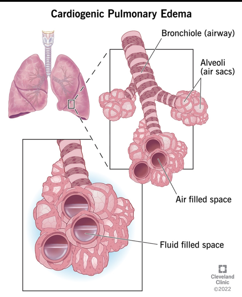 احذر.. هذه الأعراض قد تدل على وجود ماء على الرئة